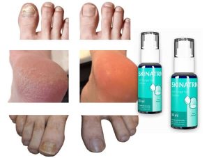 Skinatrin Recenzja – Naturalny krem w sprayu do aktywnej walki z grzybicą paznokci w 2022 r.